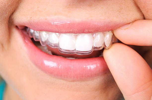 Aligner Invisible Braces
