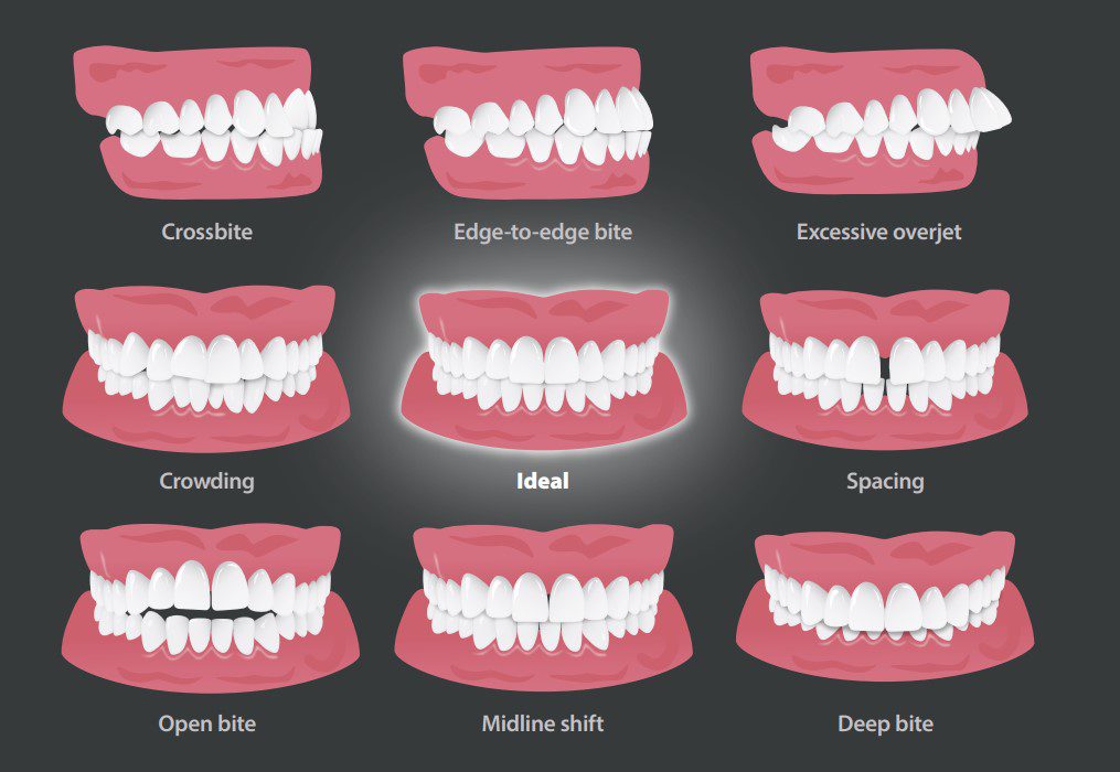 ClearCorrect 2 Types of dental malocclusions