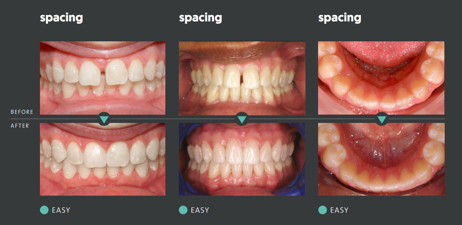 ClearCorrect 4 Before and after dental spacing correction